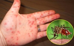 Tái nhiễm virus dengue có thể làm bệnh sốt xuất huyết nghiêm trọng hơn
