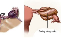 Nữ bệnh nhân 43 tuổi bị u buồng trứng xoắn 3 vòng