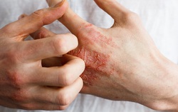 2 bộ phận trên cơ thể bị ngứa là dấu hiệu mắc bệnh tiểu đường