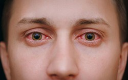 10 nguyên nhân gây đỏ mắt và cách điều trị