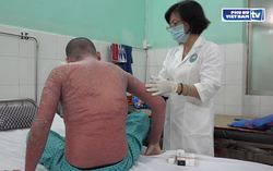 Cảnh báo việc bệnh nhân sử dụng thuốc chữa vảy nến mua qua mạng xã hội