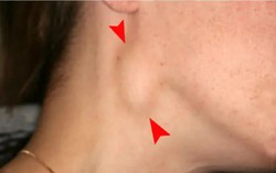 Đau họng nổi hạch ở cổ do đâu? Tình trạng này có nguy hiểm không?