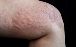 Nổi mề đay khi nào là cấp tính hoặc mãn tính? Triệu chứng có gì khác nhau không?