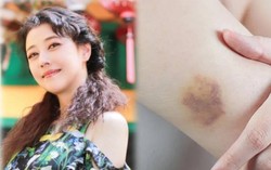 Diễn viên Châu Hải My qua đời, cơ thể đầy vết bầm tím: Nguyên nhân nào xuất hiện vết bầm tím?