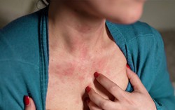 Điểm khác biệt giữa nổi mề đay do dị ứng mùa Xuân với bệnh Chàm