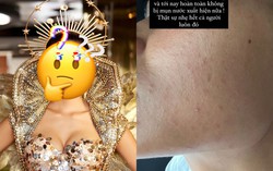 Một hoa hậu suýt hỏng da bởi sử dụng kem có corticoid