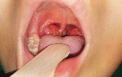Hướng dẫn cách chăm sóc trẻ sau nạo viêm VA