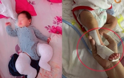 Con bị tật bàn chân khoèo bẩm sinh, mẹ hối hận vì lúc mang bầu ngồi sai tư thế