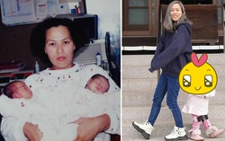 Cặp sinh đôi kỳ lạ nhất thế giới: Chào đời giống y đúc, ngoại hình lúc trưởng thành gây bất ngờ