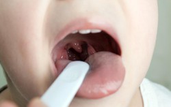 Hướng dẫn cách phân biệt viêm VA và viêm họng
