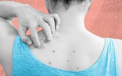 Các biện pháp giảm mụn lưng tự nhiên giúp chị em tự tin chào hè