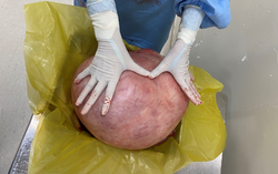 Khối u hơn 11kg chèn ép khoang bụng người phụ nữ