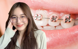 Ưu, nhược điểm của các phương pháp niềng răng hiện có