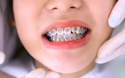 Bác sĩ tiết lộ sự thật về lời đồn "cứ niềng răng là bị hóp má" và nguyên tắc cần nhớ để khắc phục