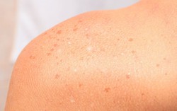 Tìm hiểu về tình trạng đốm trắng trên da do ánh nắng mặt trời