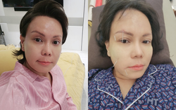 Việt Hương bị méo mặt, toàn thân phủ kín bởi 50 cây kim châm cứu 