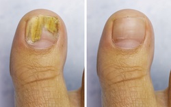 Các biện pháp phòng ngừa nấm móng vào mùa hè