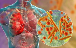 Viêm phổi do Mycoplasma: Dấu hiệu, nguyên nhân và cách điều trị