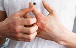 2 bệnh nhân mắc giang mai ác tính hiếm gặp do quan hệ đồng giới