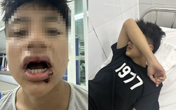 Nam sinh lớp 9 bị nhóm người lạ mặt đánh gãy 4 răng, nhấn nước khi đi tắm biển