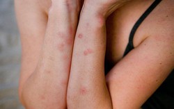 Cách nhận biết, xử lý và phòng tránh rệp giường cắn