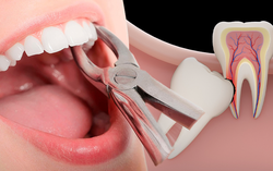 Cô gái 23 tuổi tử vong sau nhổ răng khôn: Bác sĩ chỉ ra những lưu ý tránh biến chứng nguy hiểm