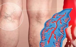 4 dấu hiệu cảnh báo cục máu đông trong cơ thể