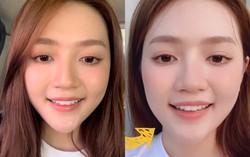 An Vy chia sẻ bị liệt dây thần kinh một bên mặt, cười nói khó khăn 