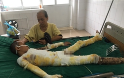 Mẹ khóc ngất cầu cứu vì con trai bị điện giật bỏng nặng không tiền cứu chữa