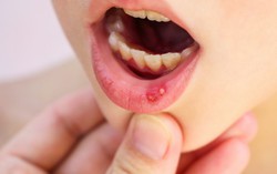 Chuyên gia chia sẻ cách chăm sóc cho trẻ khi bị nhiệt miệng