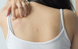 “Thổi bay” mụn lưng, mụn mông với Gel tắm thiên nhiên - Lựa chọn thông thái giúp body thêm gợi cảm
