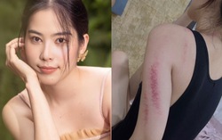 Nam Em gây lo lắng khi để lộ cánh tay đỏ bầm kèm chia sẻ đầy tâm trạng