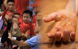 Từ vụ bé trai bị bỏng do pháo sáng trên sân Hàng Đẫy: Bác sĩ lưu ý khi xử trí vết bỏng