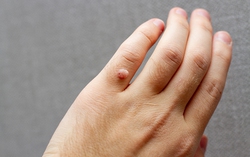 Mụn cóc có "nhảy" từ người này sang người khác và gây nguy hiểm hay không?