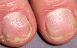 Móng tay có chấm lỗ là bệnh gì? Có điều trị được không?