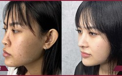 Thay đổi dáng mũi là thay đổi cả khuôn mặt, bạn tin không? 