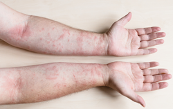 Viêm mô tế bào là gì? Những điều cần biết về tình trạng này