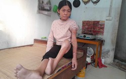 Người phụ nữ đơn thân tật nguyền nhiều năm bám bệnh viện để duy trì sự sống