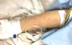 Cấp cứu thành công người phụ nữ bị sốc phản vệ sau tiêm vaccine 