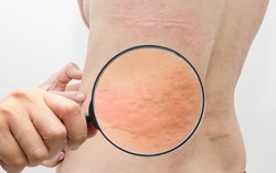 Giao mùa bị nổi mề đay nên làm gì để giảm ngứa mề đay nhanh tại nhà?