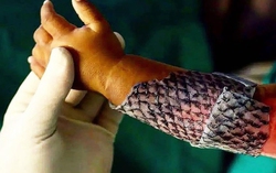 Da cá giúp điều trị bỏng và vết thương mãn tính
