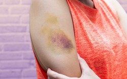 10 nguyên nhân khiến chân tay dễ bị bầm tím, trong đó có cả bệnh lý nguy hiểm