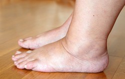 Sưng phù bàn chân là bệnh gì? Sưng bàn chân có phải dấu hiệu bệnh tiểu đường?