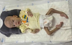 Ánh mắt cầu cứu của bé trai 6 tháng tuổi bị dị tật, chỉ nặng hơn 3kg