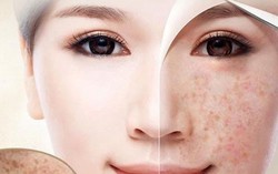 Trị nám bằng 12 nguyên liệu có trong căn bếp gia đình