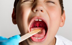 Cách nhanh nhất để biết bạn bị viêm amidan do vi khuẩn hay virus