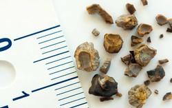 9 vị trí cơ thể có thể "mọc sỏi" và những triệu chứng nhận biết nhanh
