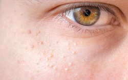 4 dấu hiệu trên làn da cảnh báo chỉ số cholesterol cao