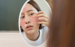 10 nguyên nhân khiến da mặt đỏ ửng