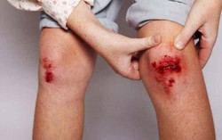 Làm thế nào để xác định xem con bạn có nguy cơ mắc bệnh máu khó đông hay không?